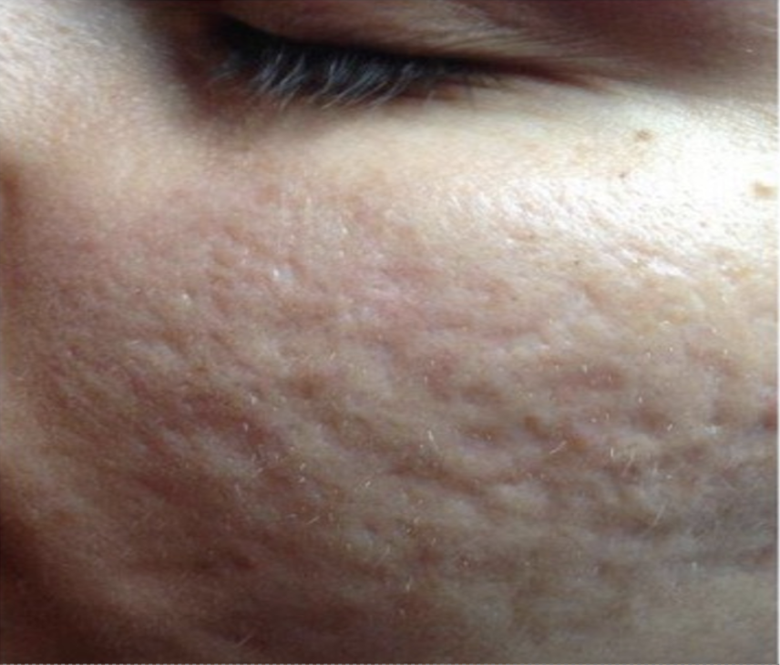 Before treatment