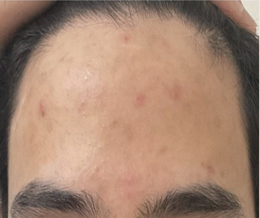 After treatment