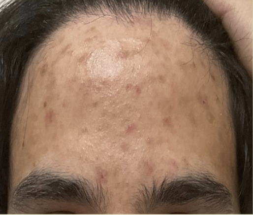 Before treatment