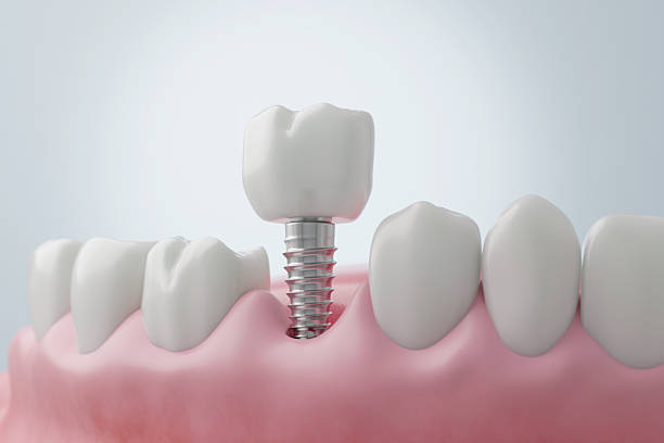 Dental Implants