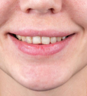 Before porcelain veneers