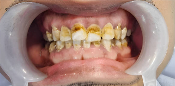 Before full mouth restoration