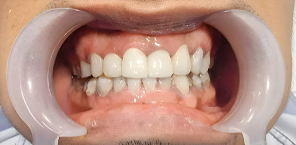 After full mouth restoration