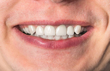 After porcelain veneers
