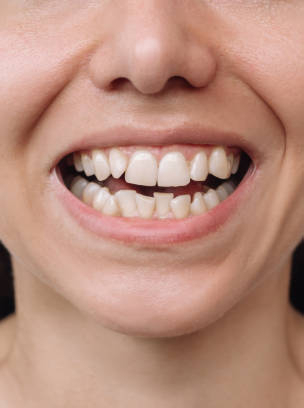 Before teeth whitening