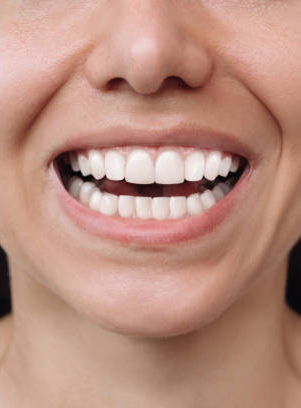 After teeth whitening
