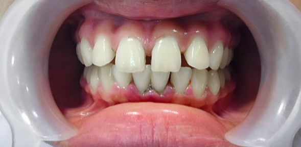 Before Invisalign