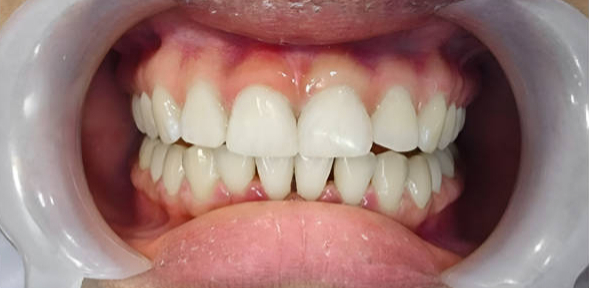 After Invisalign