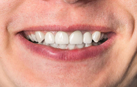 Before dental implant