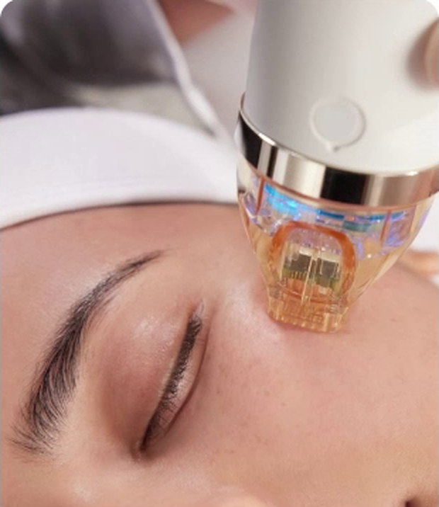 A microneedling device being used on the face