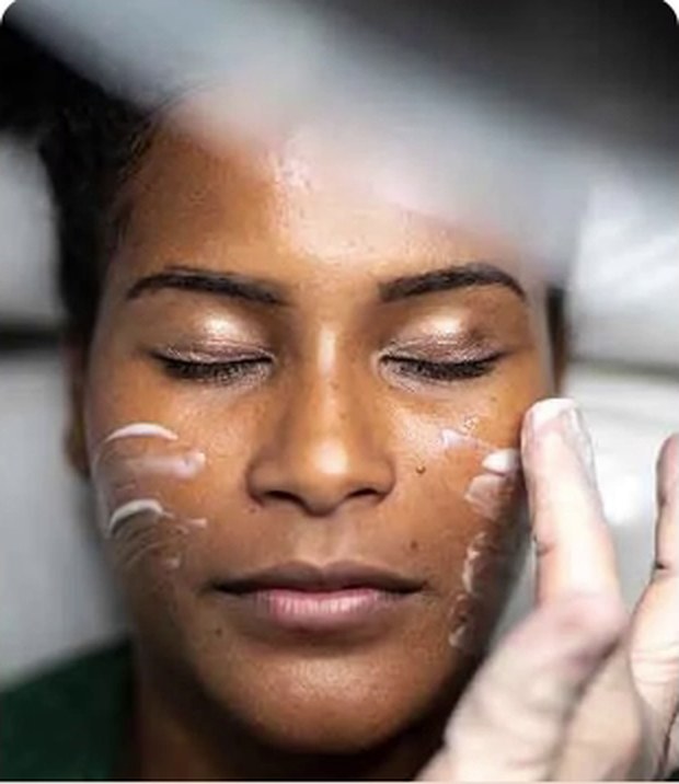 A chemical peel solution being applied to the face