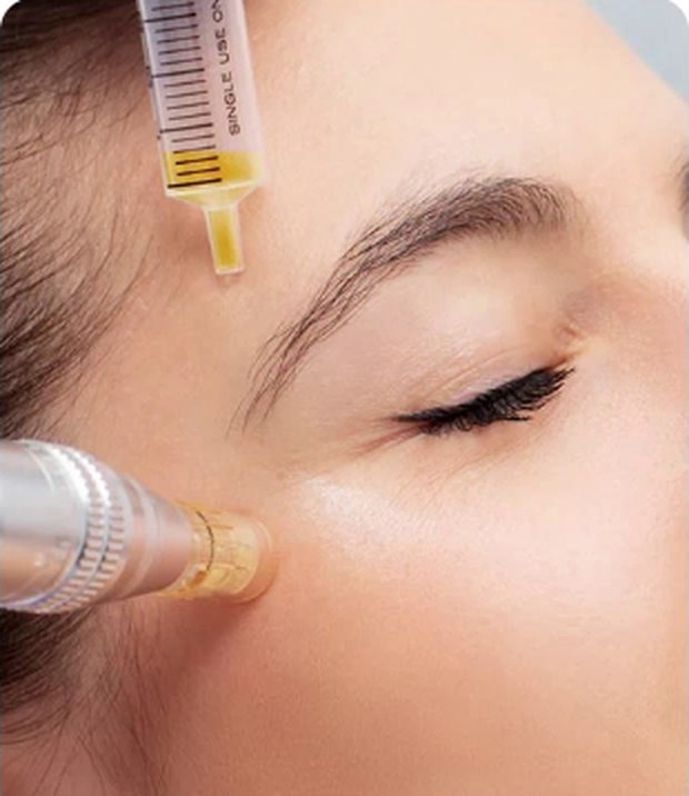 A platelet rich plasma treatment being applied to the face