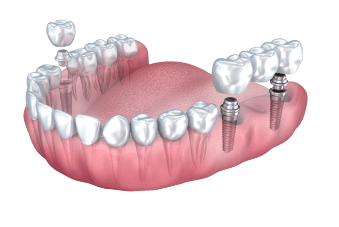 Multiple Dental Implants 