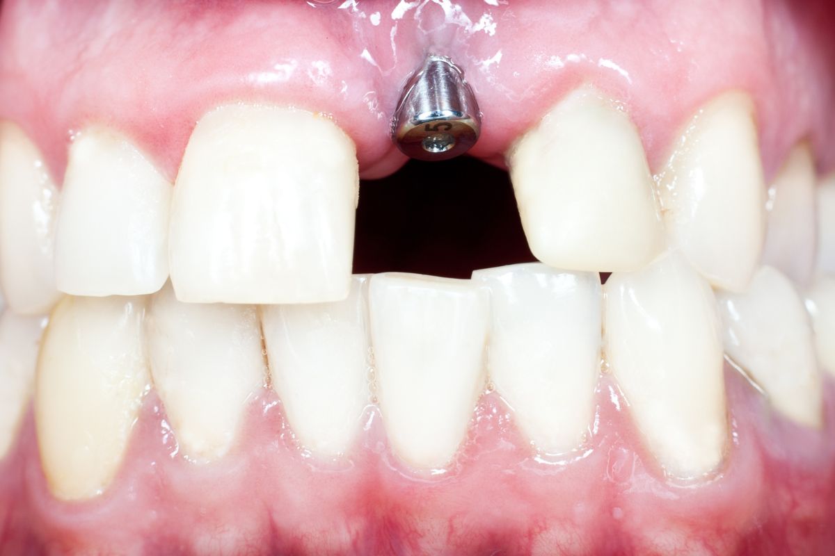 Custom dental implant crown designed for a missing tooth