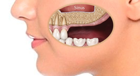 Sinus Lift in Albuquerque, NM