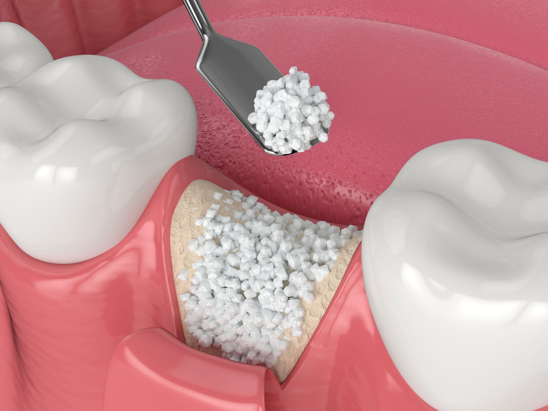 Bone Grafting in Albuquerque, NM