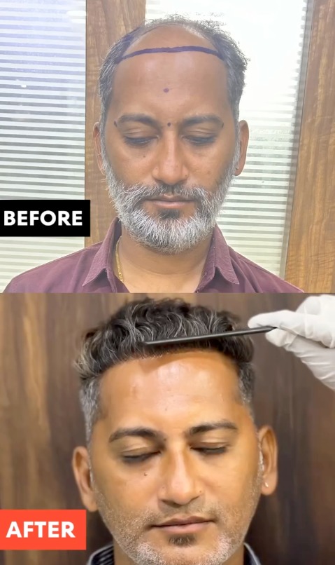 Patient Result 2 - Before & After Hair Transplant