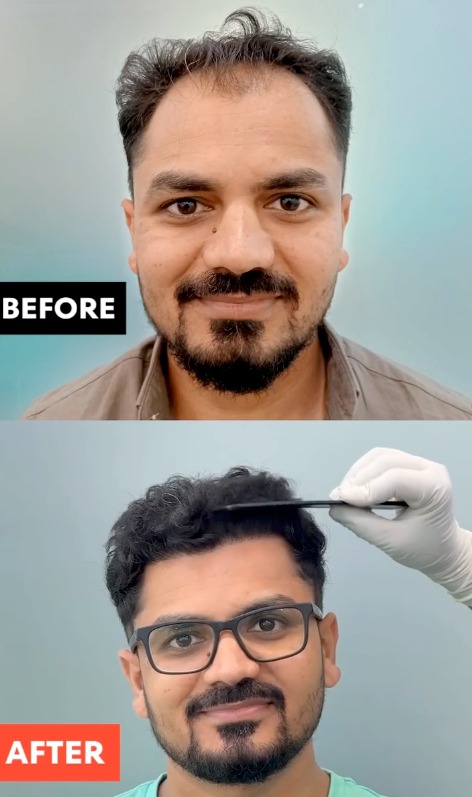 Patient Result 1 - Before & After Hair Transplant