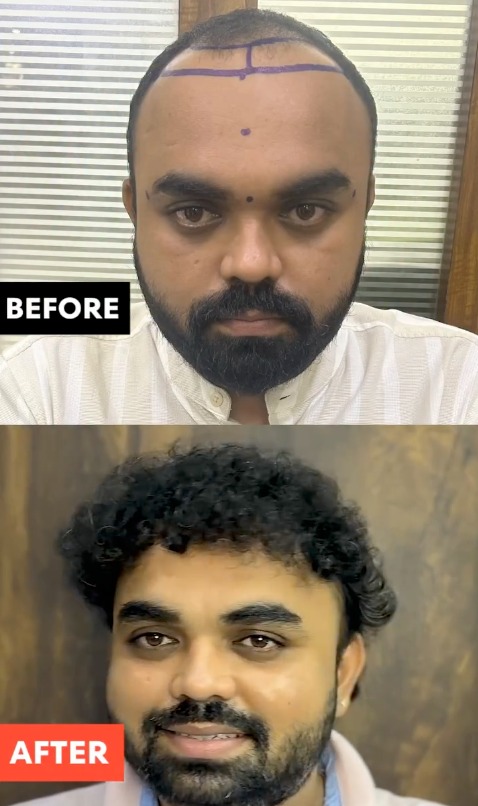 Patient Result 3 - Before & After Hair Transplant