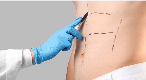 Diagrama de sutura muscular en cirugía de abdominoplastia Ecuador.