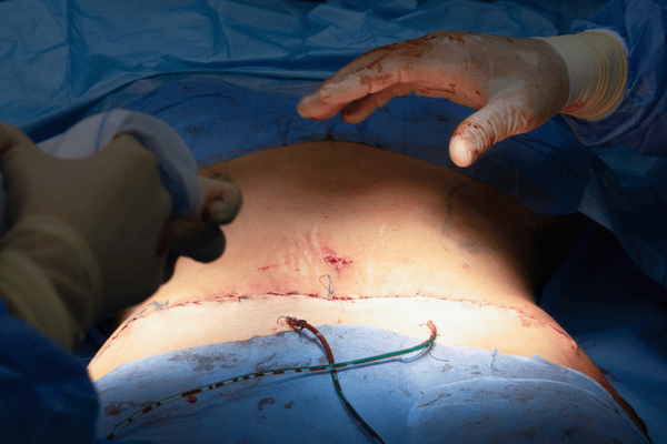Foto de una abdominoplastia