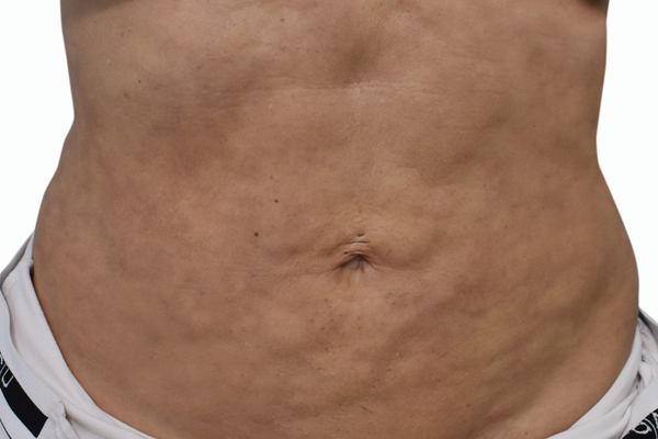 Foto de un abdomen con fibrosis