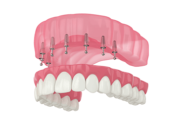 High-quality Dental Implants