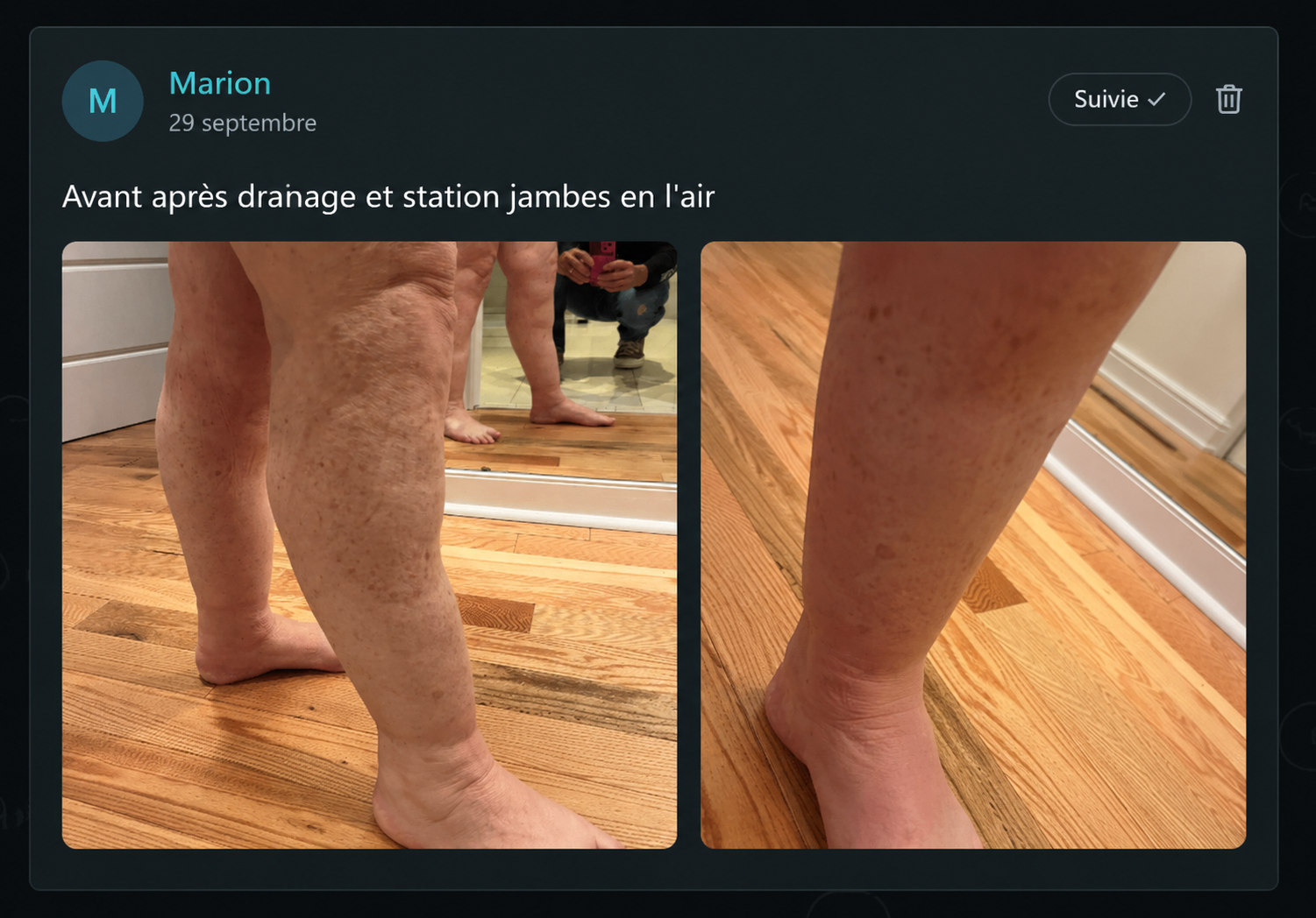 Avis de Marion sur ses jambes