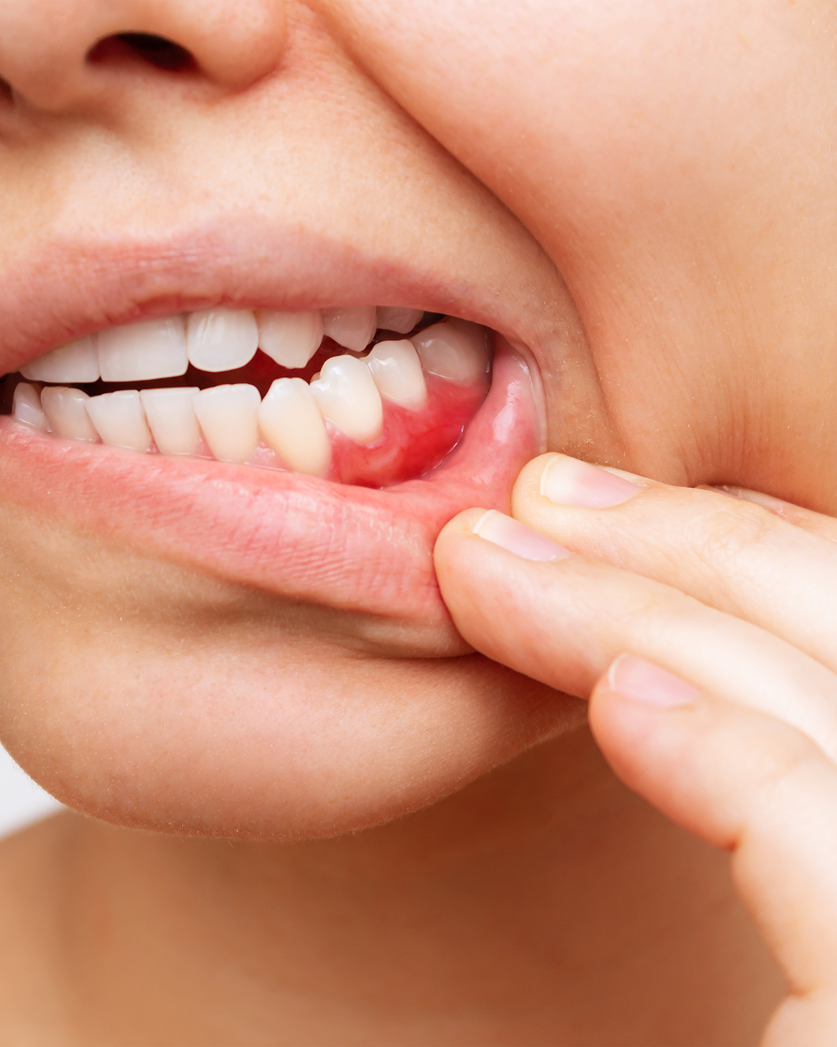 Close-up image of a person's lower half of the face, pulling down the lower lip with their right hand to reveal red, inflamed gums, indicating possible gum disease.