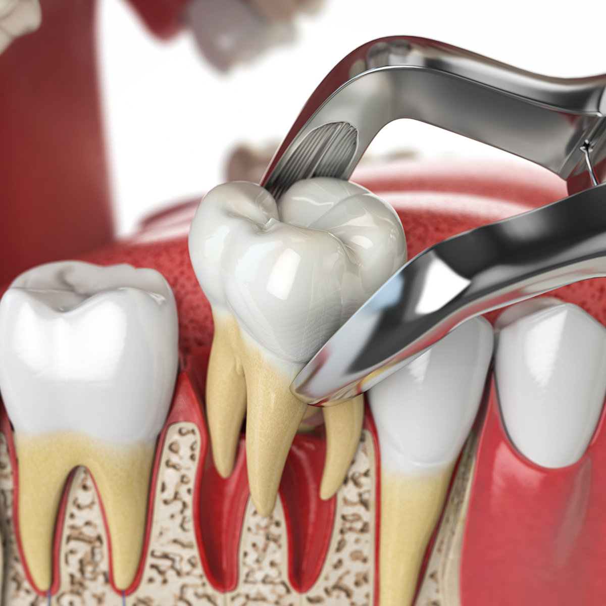 3D illustration of a tooth being removed with forceps