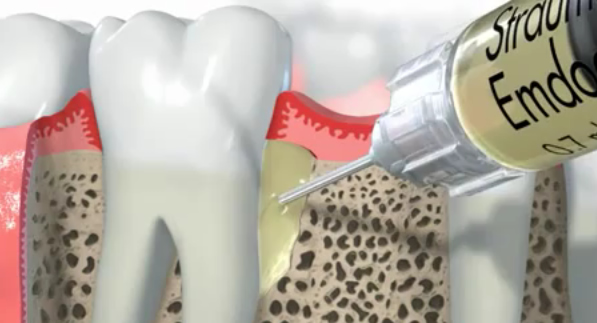 a cross section 3D illustration of a syringe full of emdogain being injected into the bone surrounding tooth