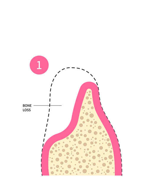 Illustration of cross section showing bone loss