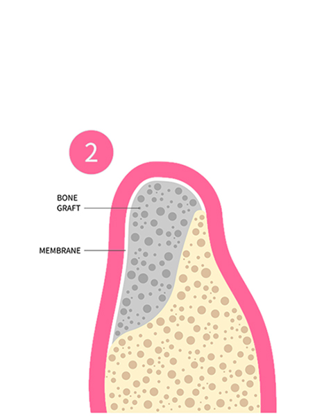 a cross section illistration showing bone grafting and membrane