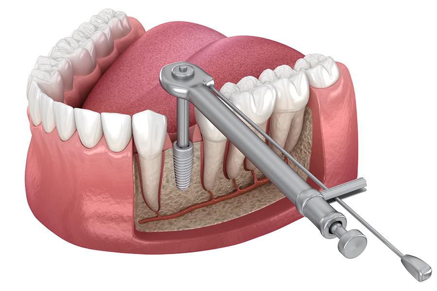 A close-up of a model of teeth with the gum removed with wrench testing integration and stability