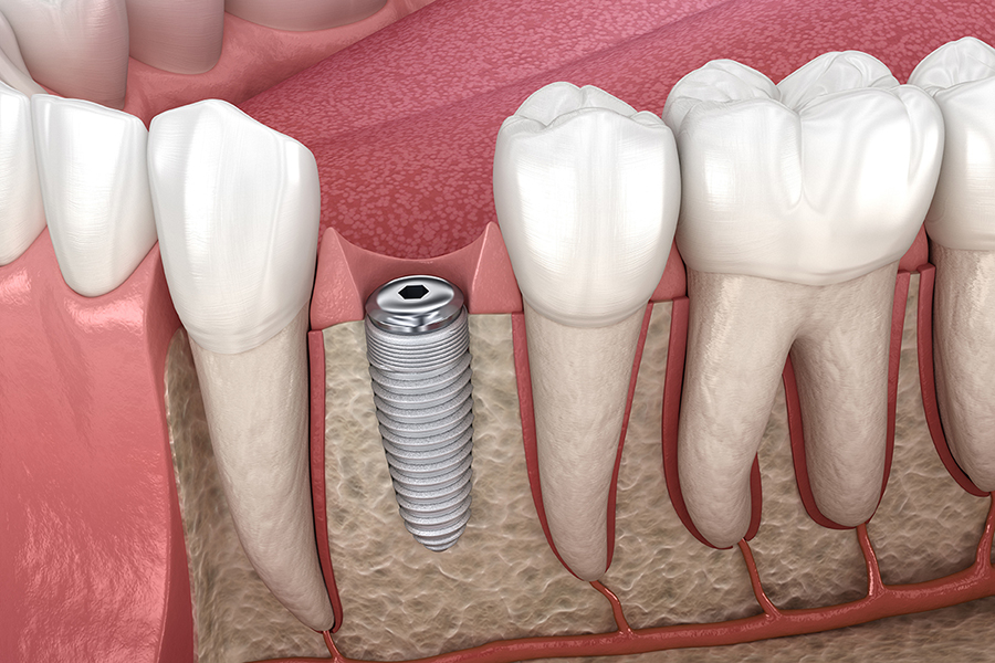 A close-up of teeth and a dental implant in the bone