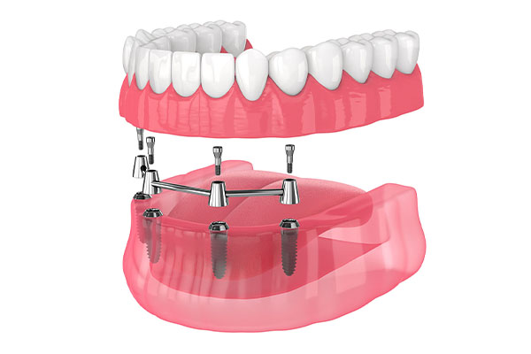 Image of an All on 4 implant prosthesis with titanium bar screw retained. 