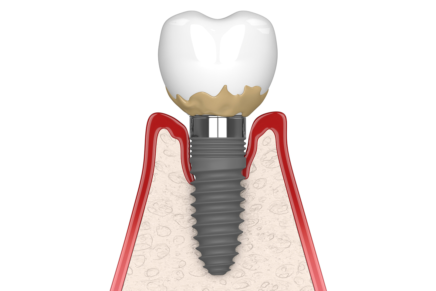 Cross section showing bone loss around implant