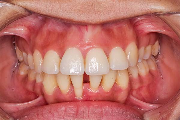 Close-up of a mouth with cheeks retracted showing all of the teeth with very red inflamed gums and gaps between teeth, signs of periodontal disease.