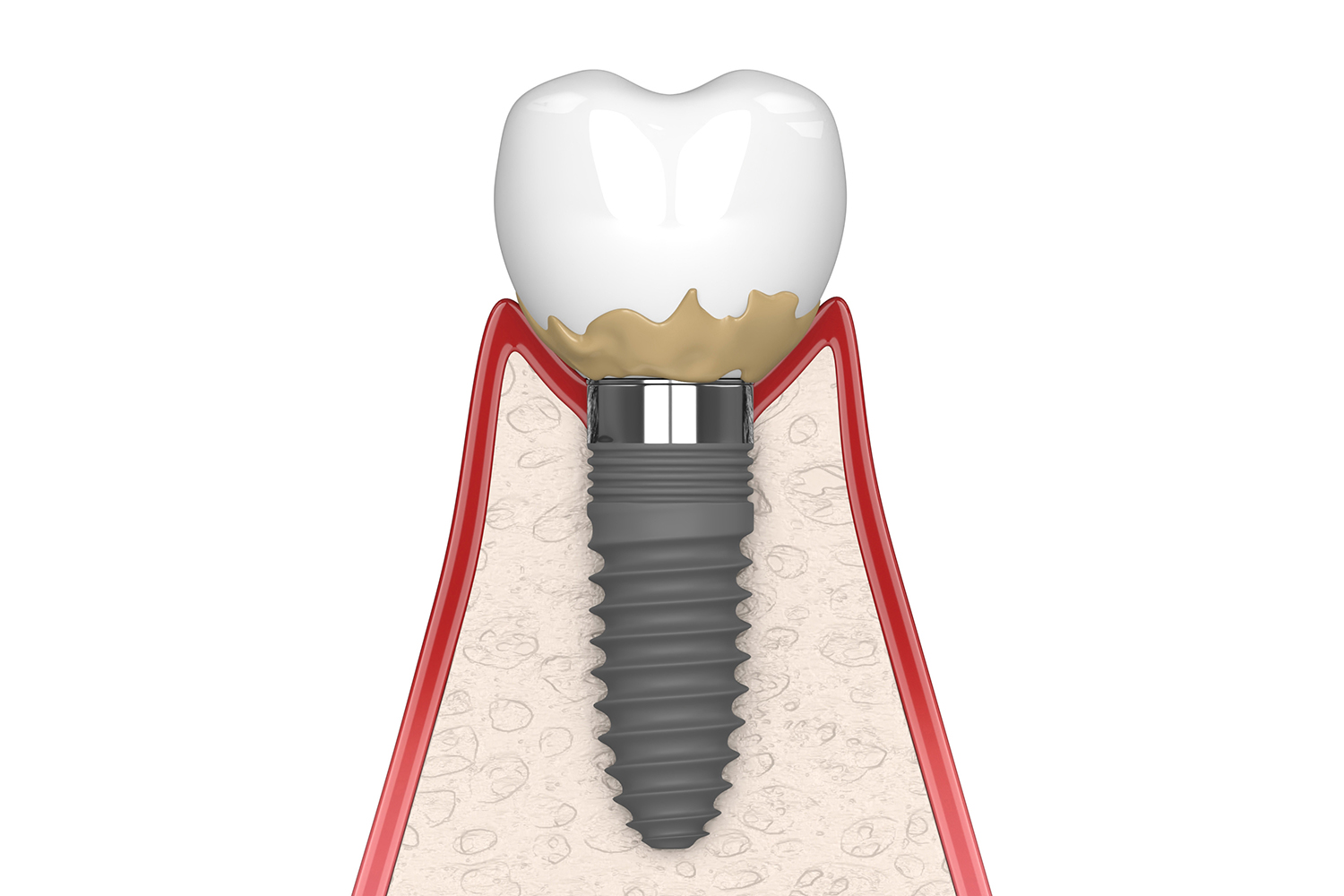 Cross section showing the beginning stages of implant disease