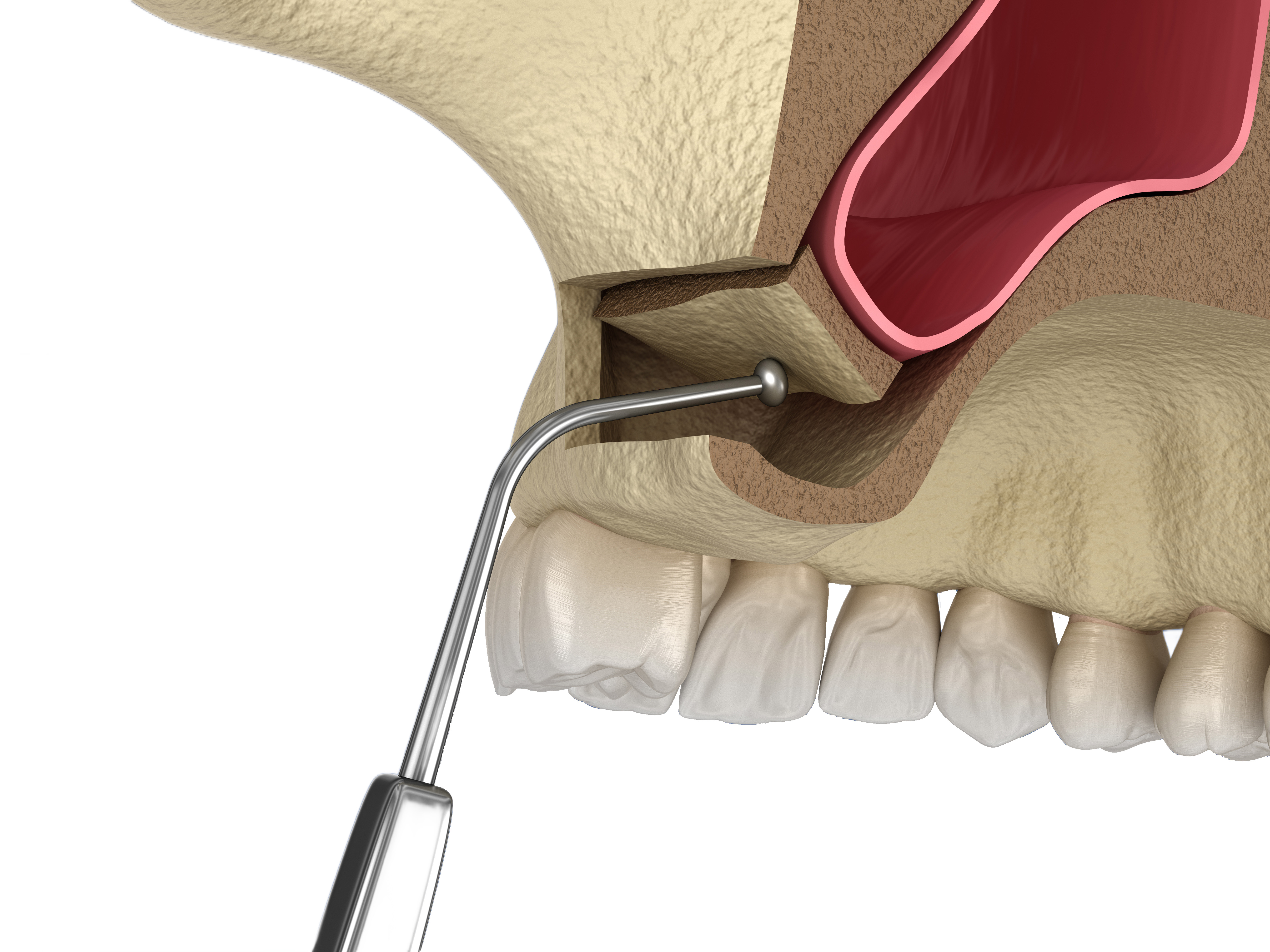 3D illustration showing instrument inserted into lateral window