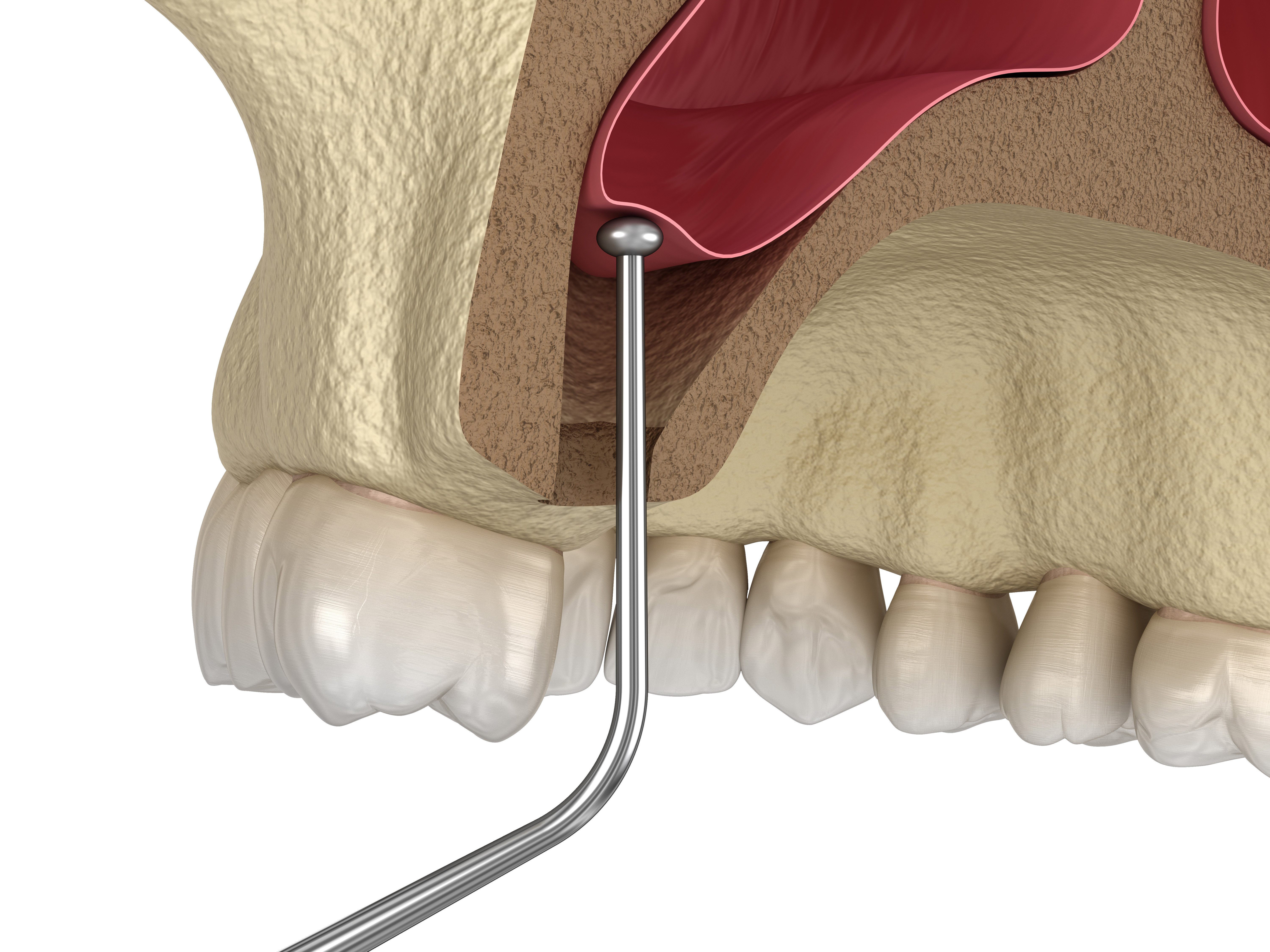 3D illustration showing instrument raising the floor of the sinus