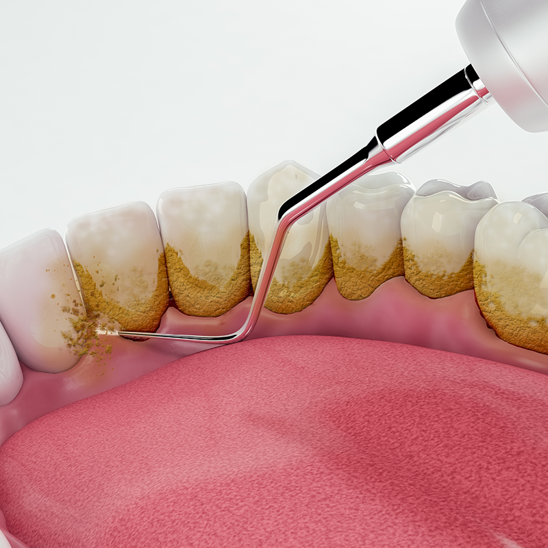 Illustration of periodontal therapy, showing a close-up view of a dental scaler removing plaque and tartar from the teeth at the gum line, which are depicted with a slight gingival inflammation.