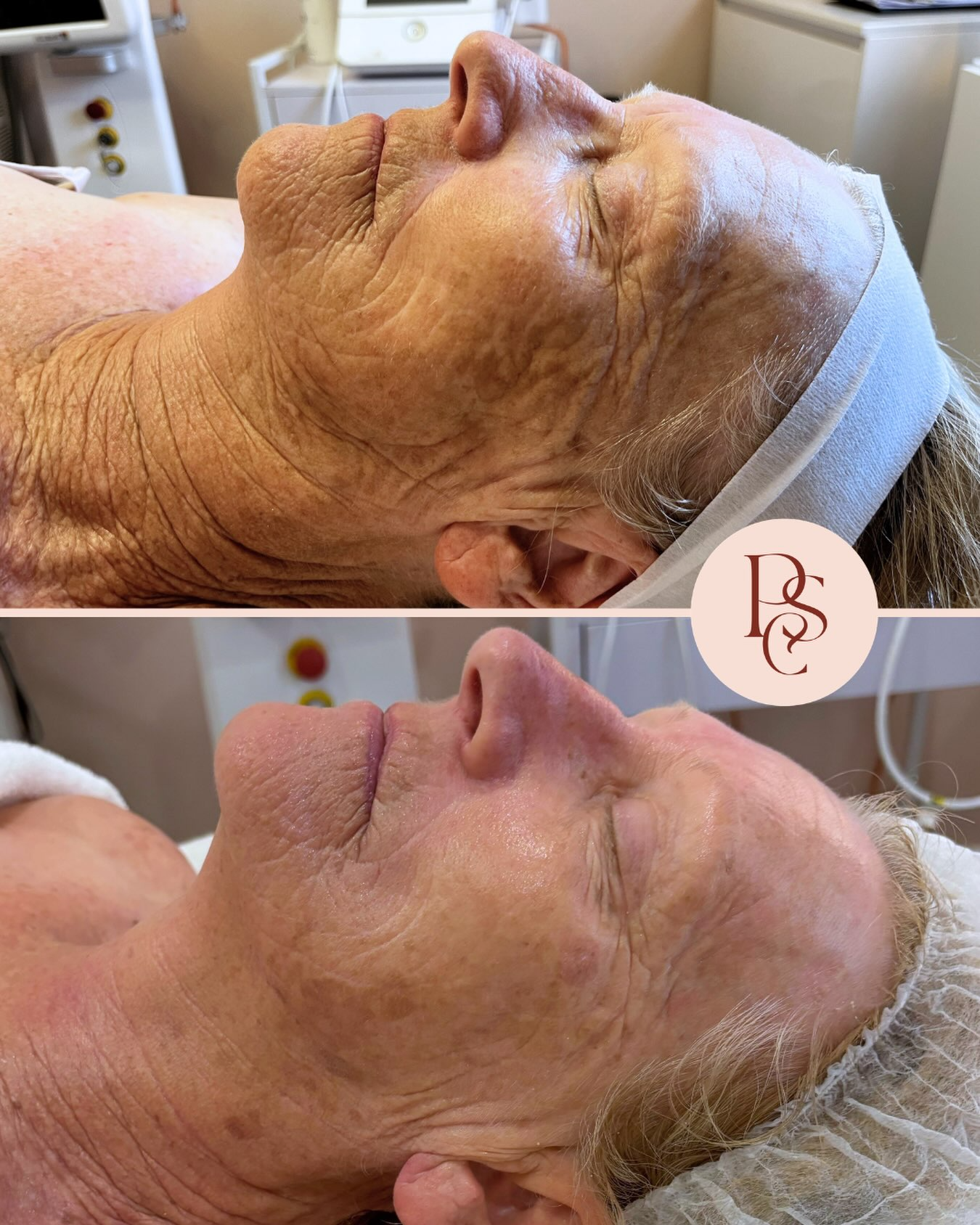 Calmer, Healthier Complexion - genuine Peachy Skin Clinic client example