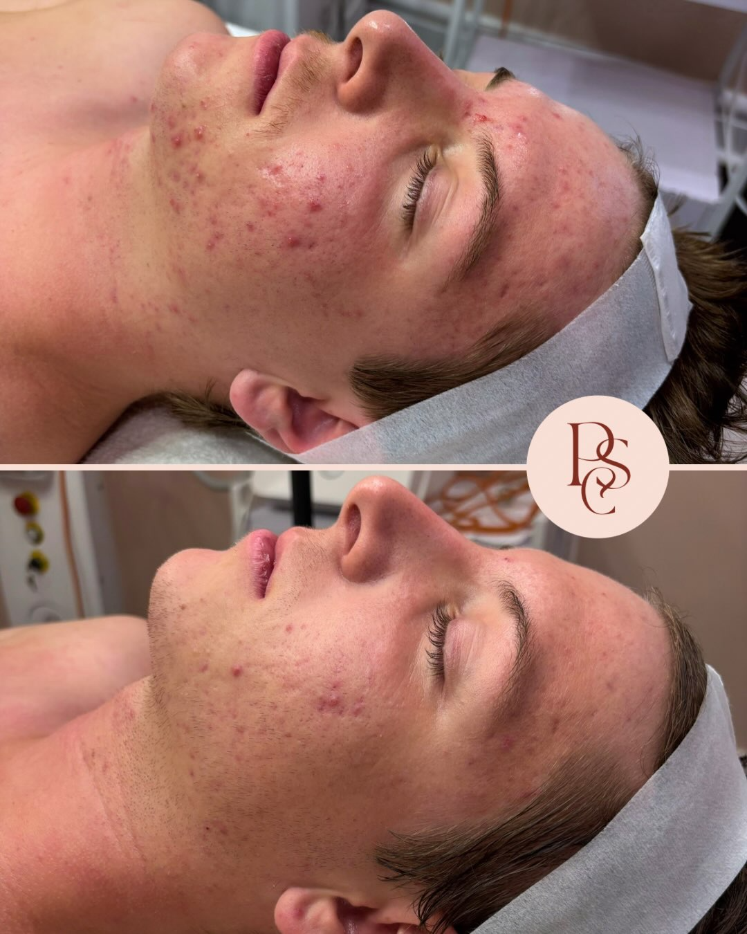 Smoother, More Radiant Skin - genuine Peachy Skin Clinic client example