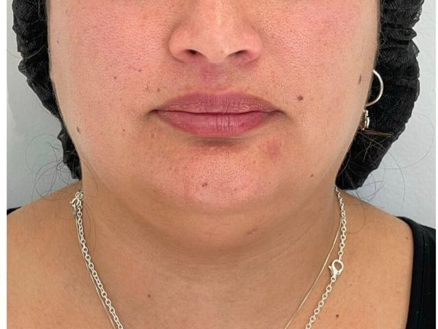 Caso 03: registro inicial del contorno mandibular