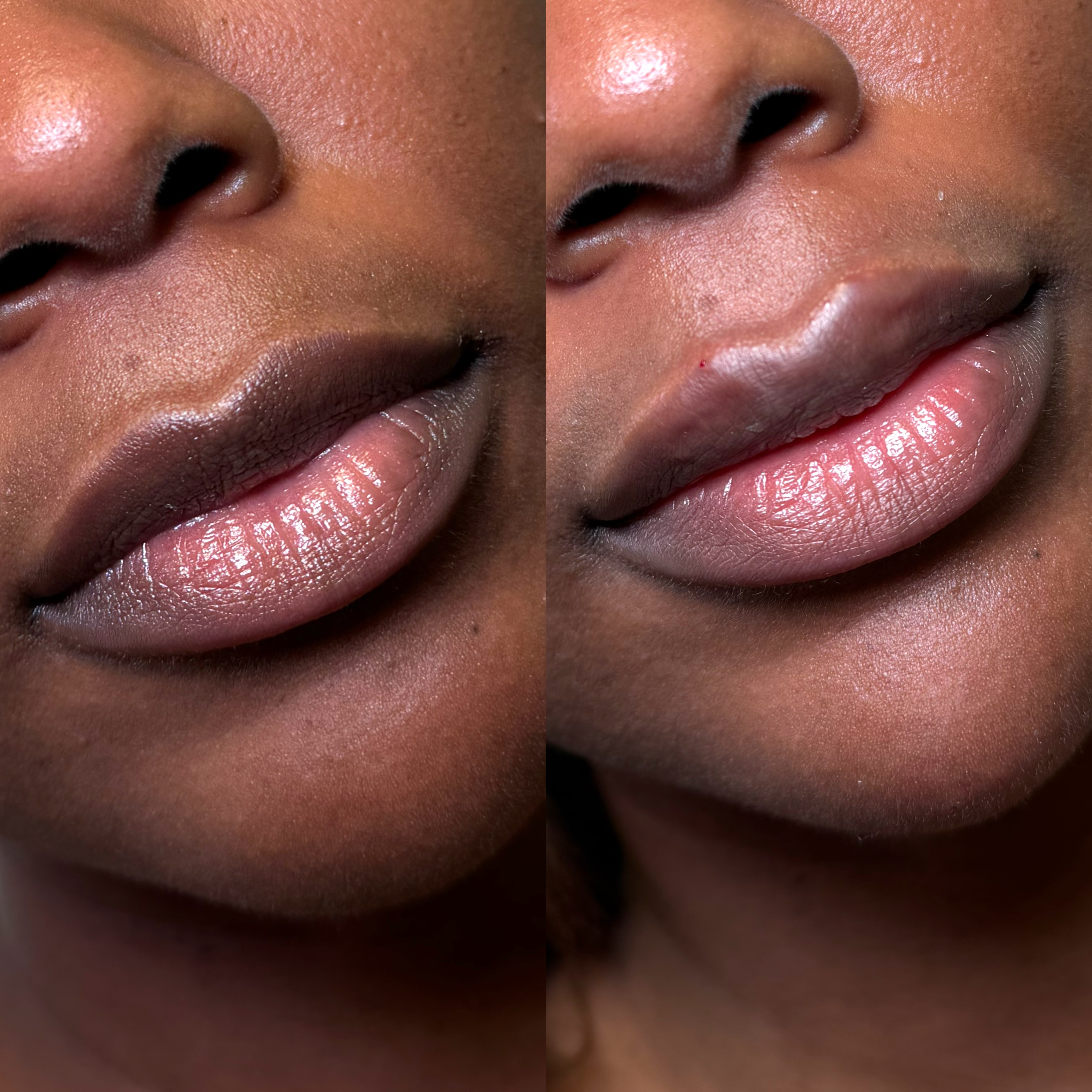 Lip Filler Before and After