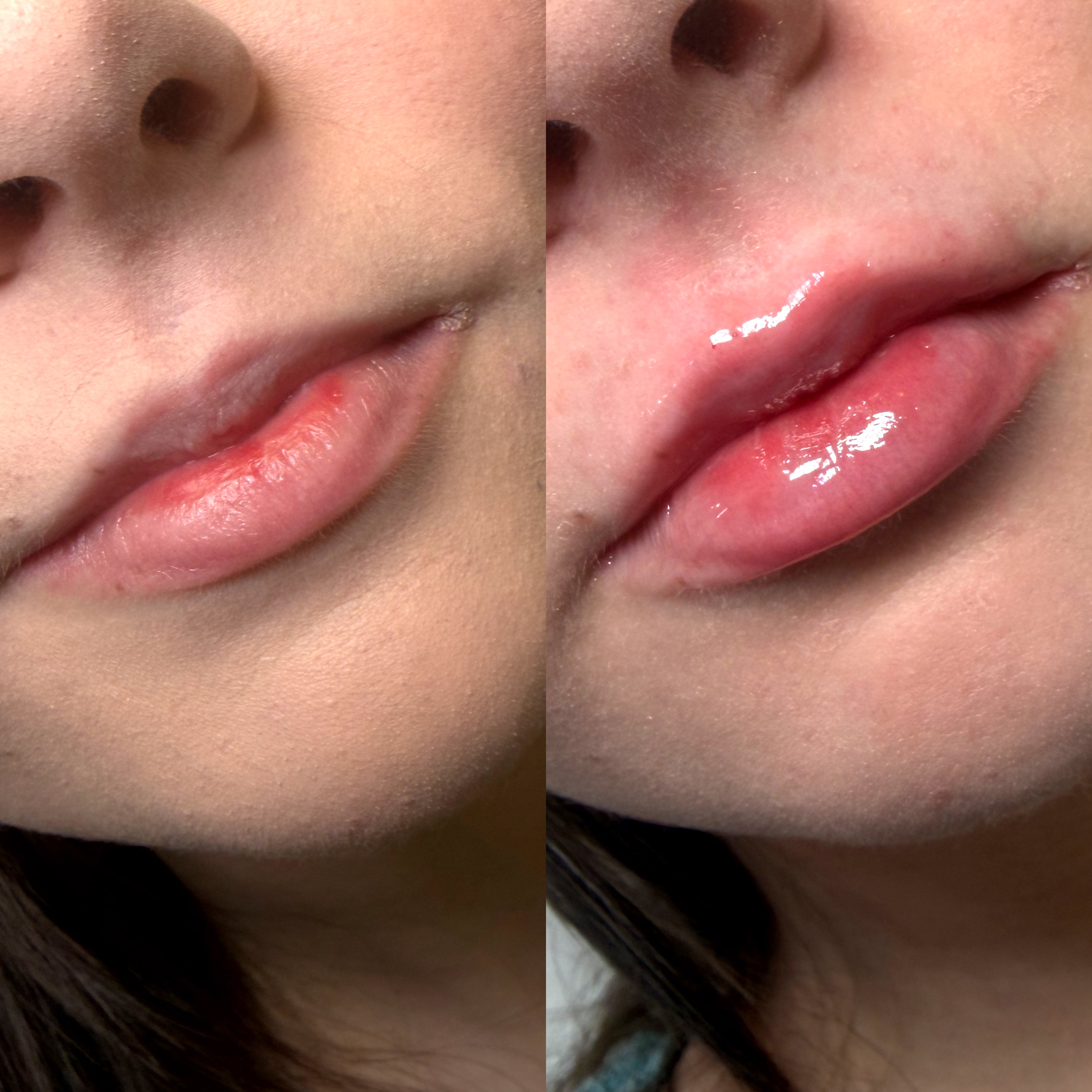 Lip Filler Before and After