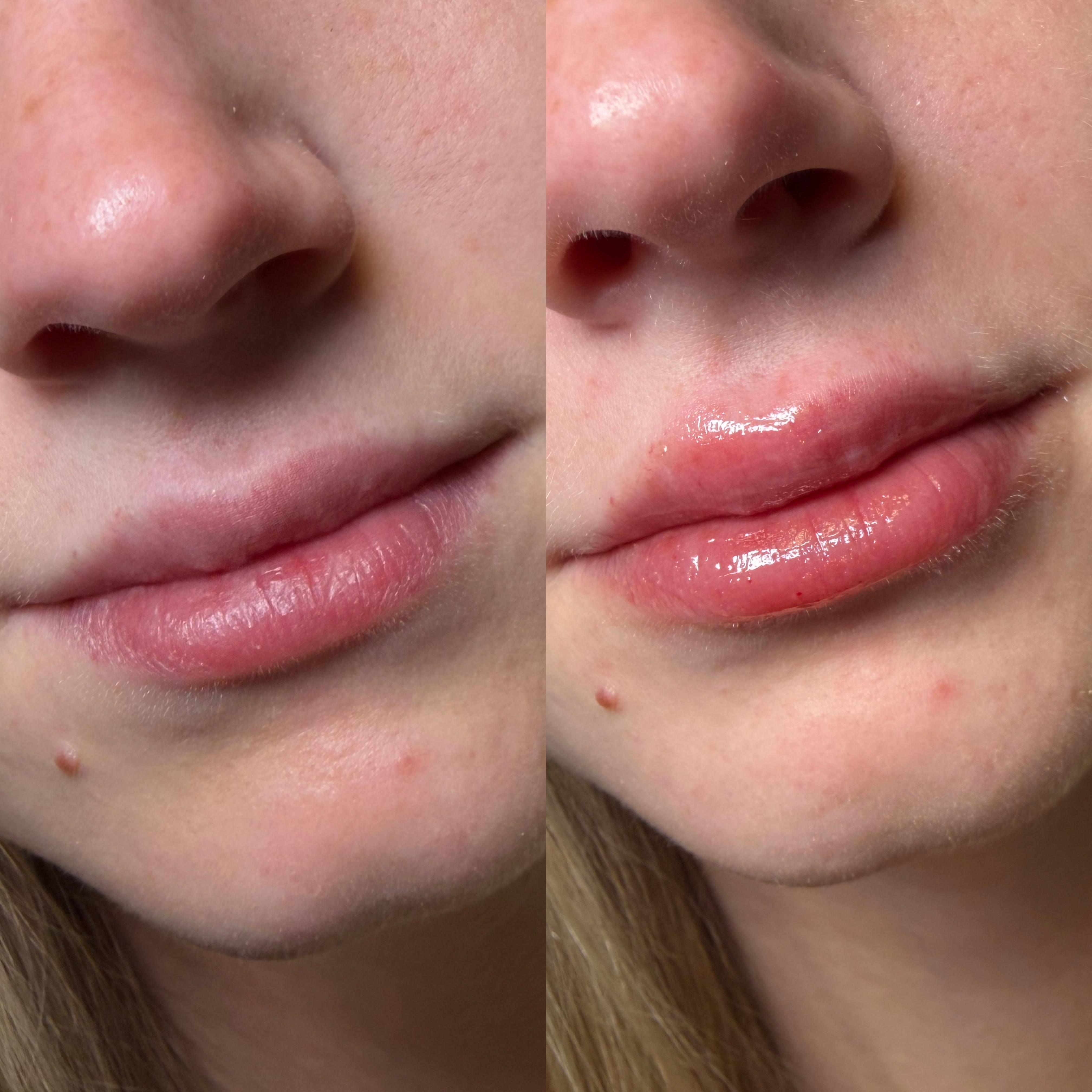 Lip Filler Before and After