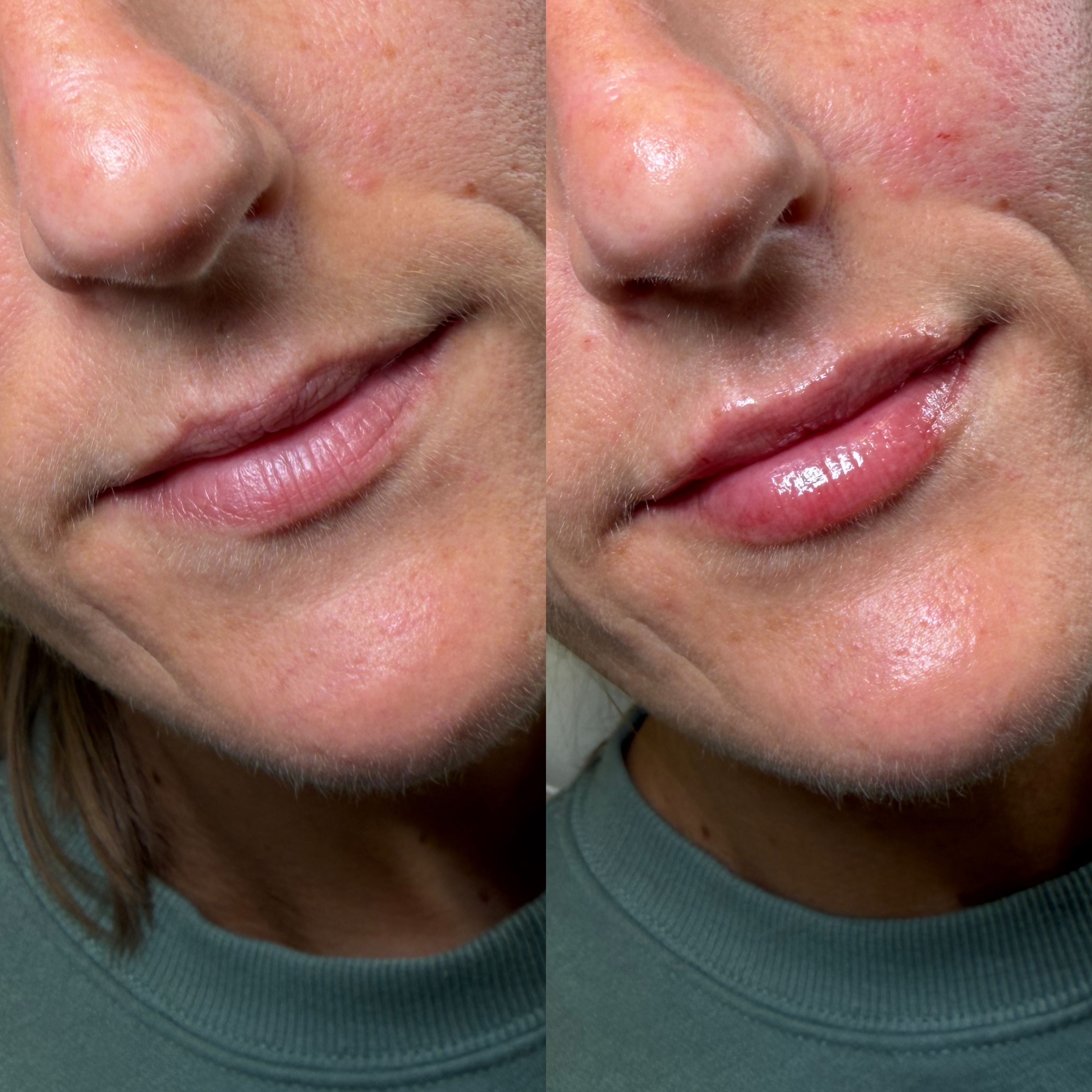 Lip Filler Before and After