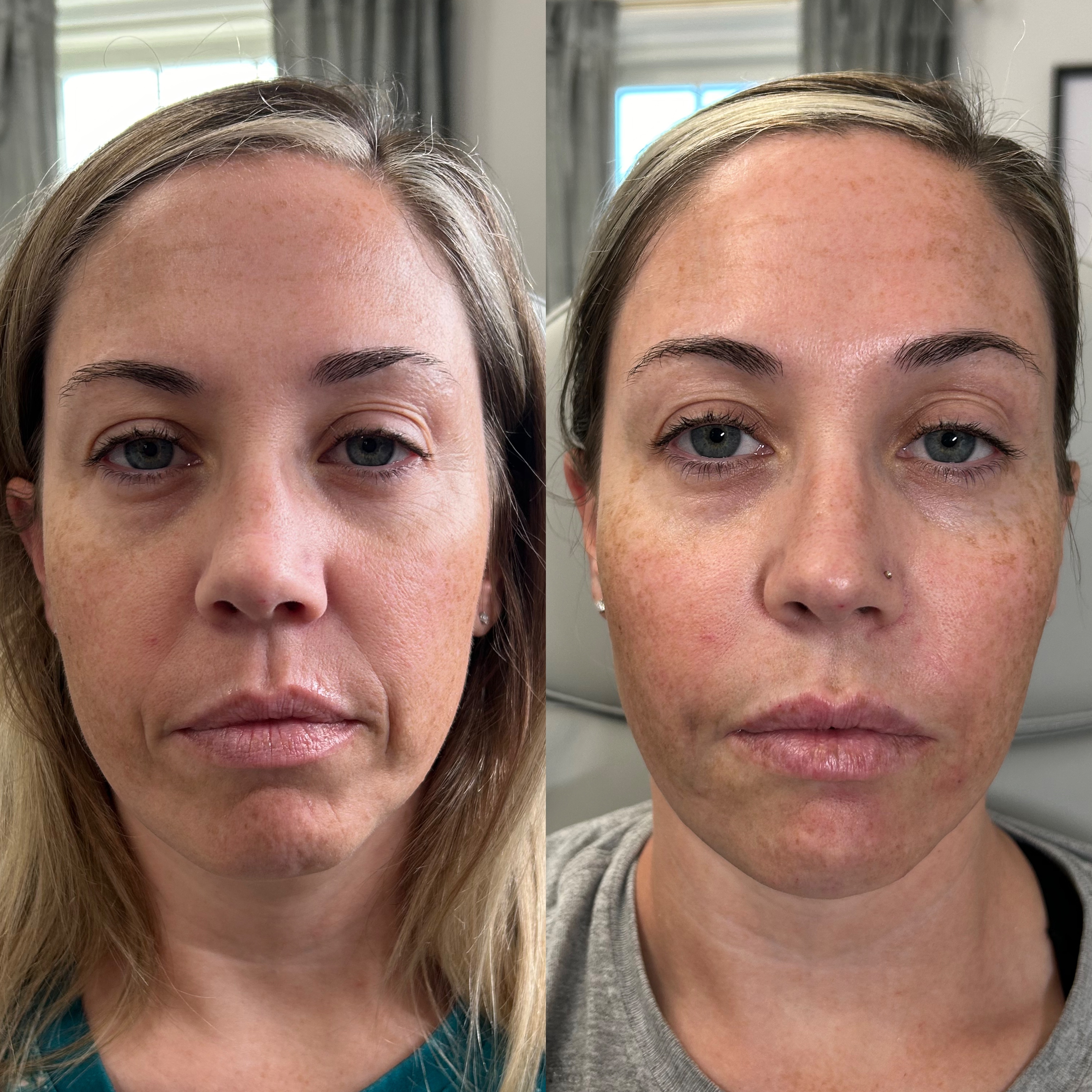 Facial Balancing Before and After